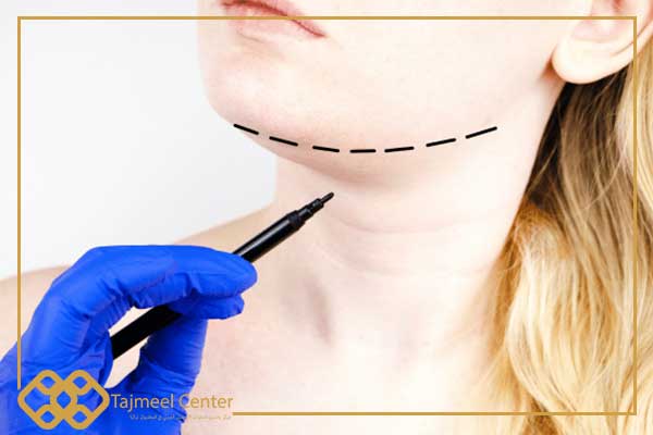 Chirurgia plastica del collo in Turchia
