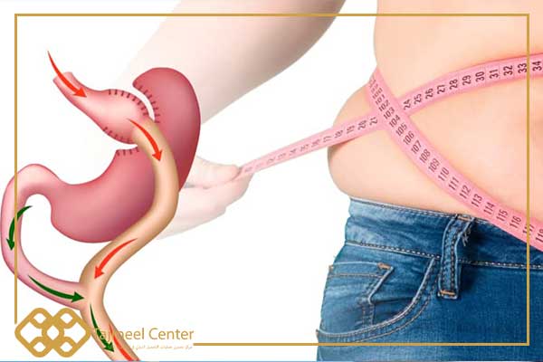 Bypass gastrico in Turchia