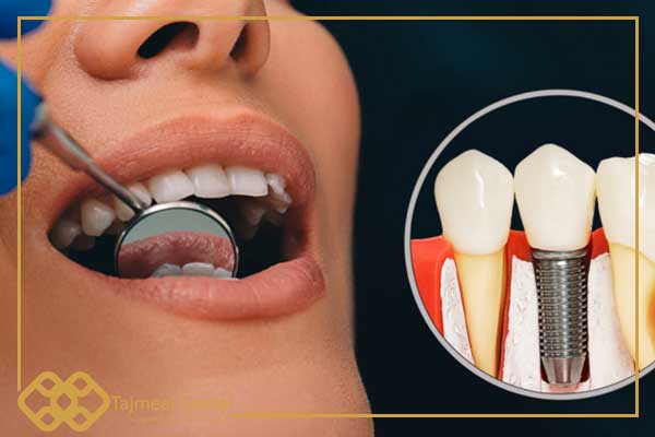 Dental implants in Türkiye