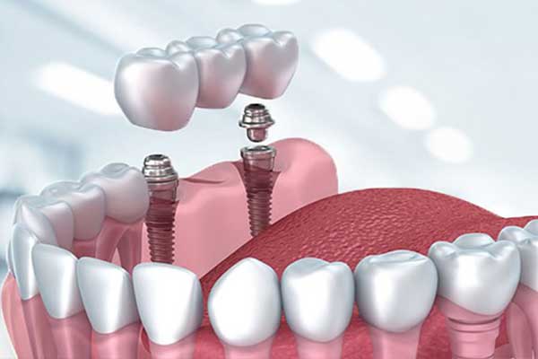 Зъбен имплант в Турция