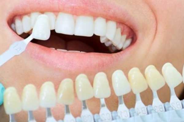 Зъбни фасети в Турция