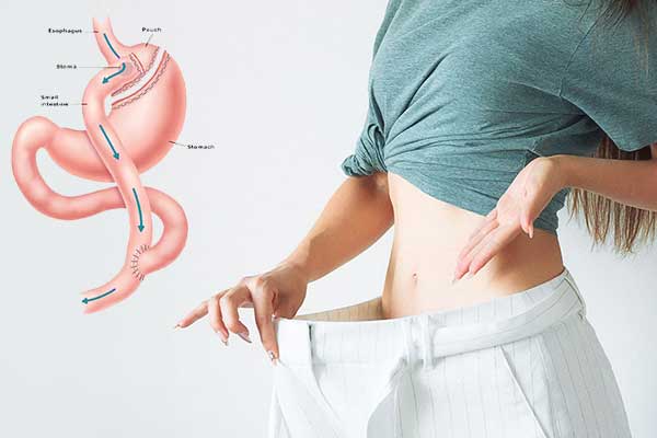 Gastric bypass surgery in Turkey