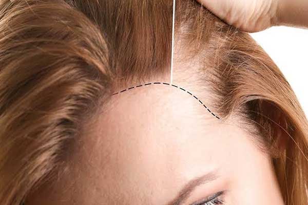 kvinnelig hår restaurering kalkun