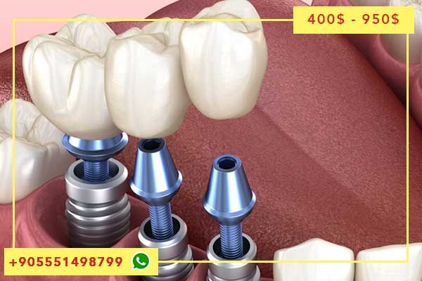 اسعار تركيب الاسنان في تركيا