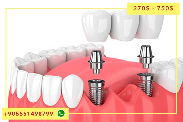 تكلفة زراعة الأسنان الفورية في تركيا