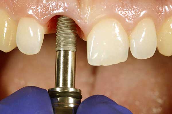implantes dentales en turquía opiniones