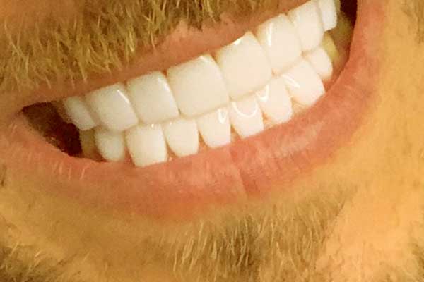 Carillas Dentales en Turquía: Precio y Sonrisas Perfectas
