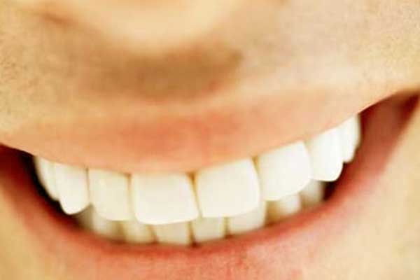 Carillas de Resina Compuesta: Una Solución Estética para tu Sonrisa