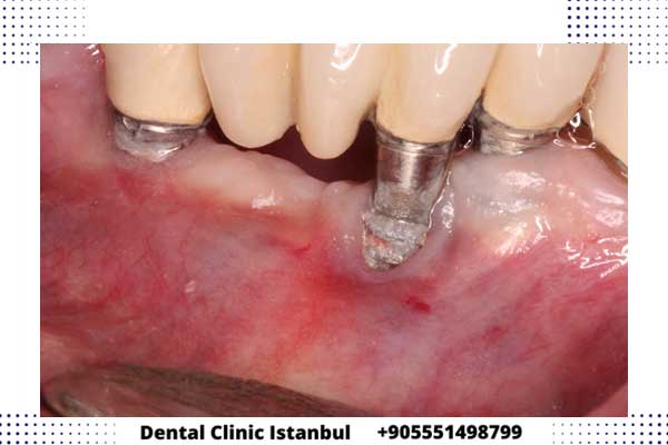 خطوات زراعة الاسنان في تركيا - مراحل ومدة الشفاء و التكلفة