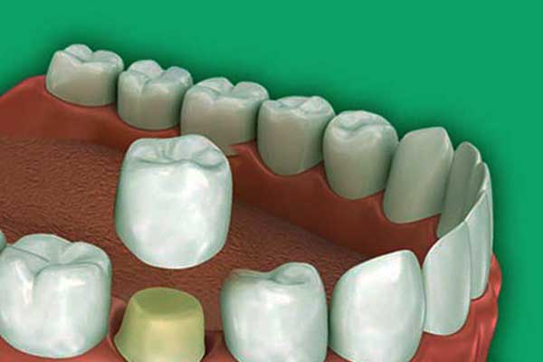 الأسنان الاصطناعية - الأنواع و مميزات وعيوب وكيف تختار بينها