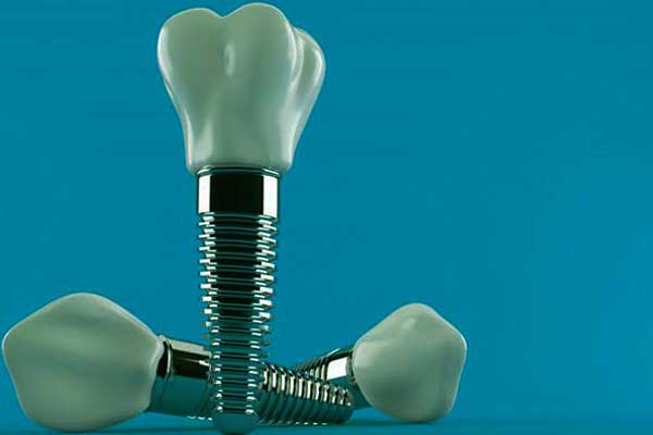 براغي الاسنان – أفضل أنواع البراغي و طرق التركيب والإستخدام