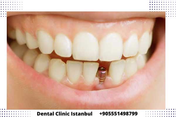 تقنيات علاج الاسنان في تركيا - أفضل الخيارات و الأسعار