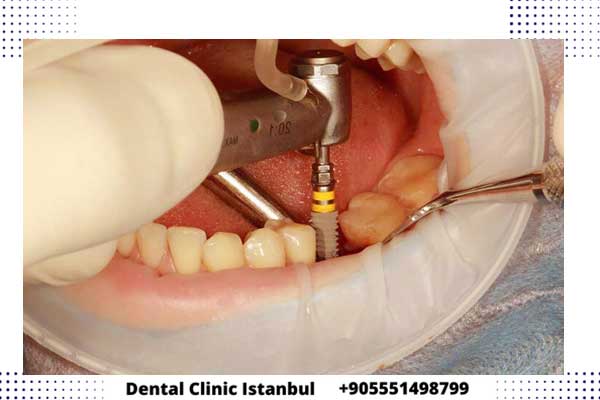 مدة زراعة الأسنان في تركيا – المراحل و الأسعار والنصائح