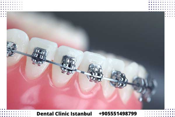 تقويم الاسنان في تركيا – أفضل انواع والخيارات لعلاج الأسنان