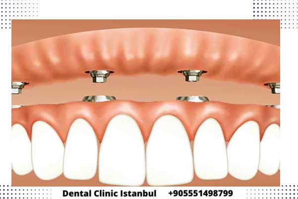 كيف تتم زراعة الاسنان في تركيا – الخطوات و المراحل بالتفصيل