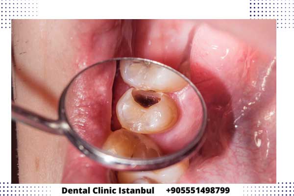 حشو الأسنان في تركيا – إصلاح الاسنان بجودة عالية