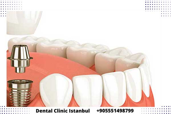 عروض زراعة الأسنان في تركيا – خصومات تصل حتى 30%