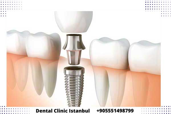أحدث تقنيات علاج الاسنان في تركيا – تكنولوجيا طب الأسنان المتقدمة