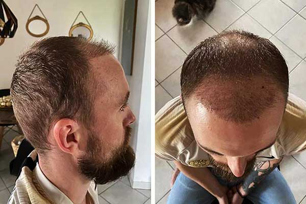 تجارب زراعة الشعر في تركيا - نتائج تجربة زرع الشعر في اسطنبول