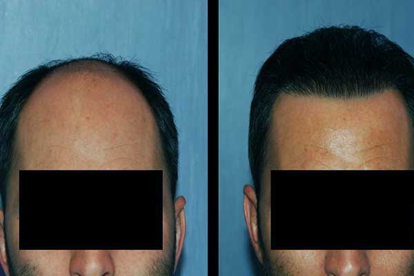 تجارب زراعة الشعر في تركيا - نتائج تجربة زرع الشعر في اسطنبول