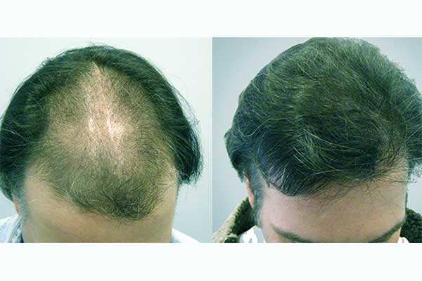 تجارب زراعة الشعر في تركيا - نتائج تجربة زرع الشعر في اسطنبول