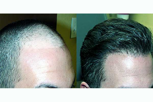 تجارب زراعة الشعر في تركيا - نتائج تجربة زرع الشعر في اسطنبول