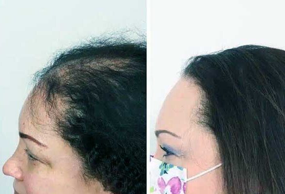 تجارب زراعة الشعر في تركيا - نتائج تجربة زرع الشعر في اسطنبول