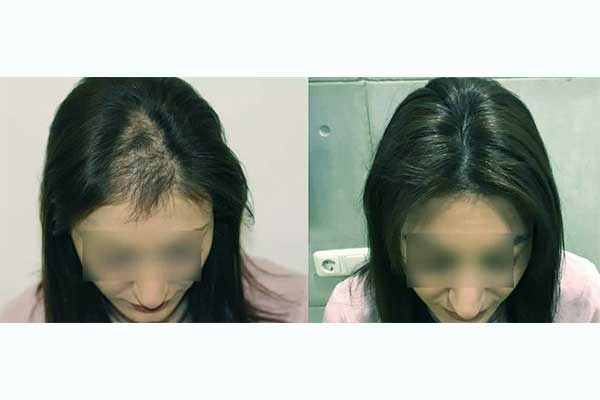 تجارب زراعة الشعر في تركيا - نتائج تجربة زرع الشعر في اسطنبول