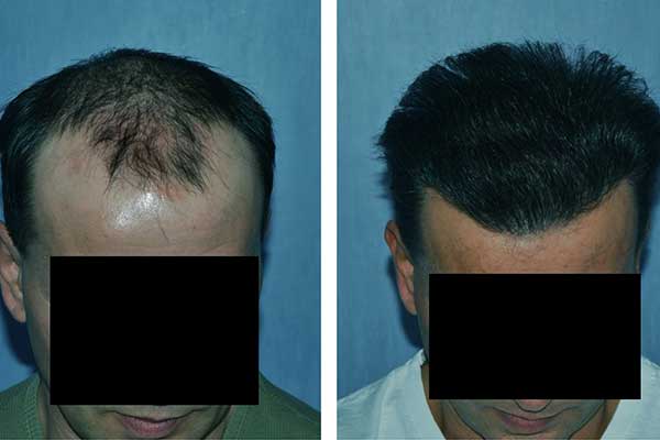 تجارب زراعة الشعر في تركيا - نتائج تجربة زرع الشعر في اسطنبول