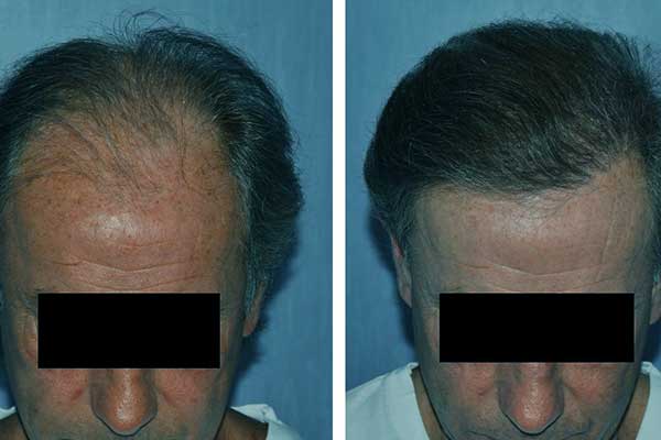 تجارب زراعة الشعر في تركيا - نتائج تجربة زرع الشعر في اسطنبول