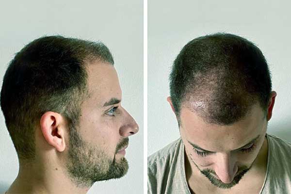 تجارب زراعة الشعر في تركيا - نتائج تجربة زرع الشعر في اسطنبول