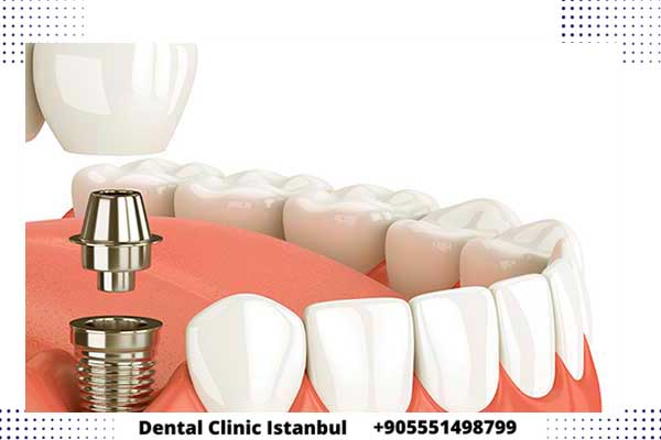 مراحل زراعة الأسنان في تركيا : تفصيل ومميزات كل نوع