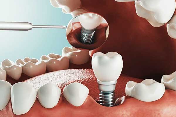 فقدان الأسنان: الأسباب، العلاجات، والتأثيرات المحتملة