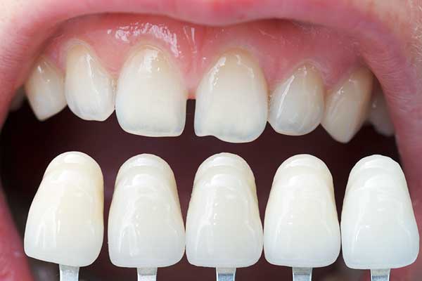 القشور المركبة (Composite Veneers): دليلك الشامل لتحسين ابتسامتك