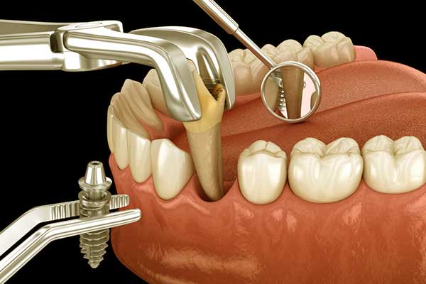 خراج الأسنان: دليل شامل للتعرف على الأسباب، الأعراض، والعلاج