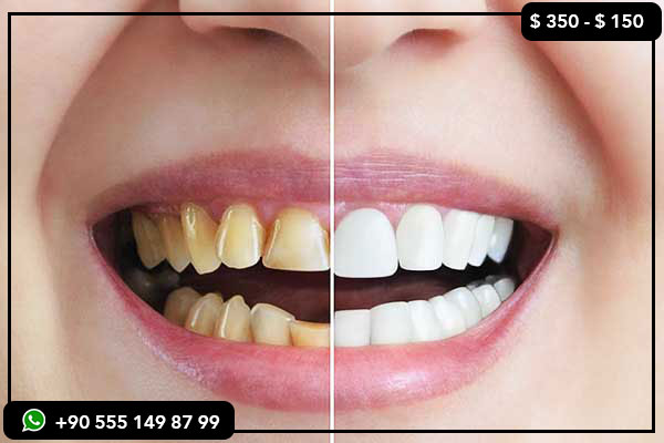 Precios de servicios dentales en Irak, implantes dentales en Turquía, carillas en Turquía, dientes en Turquía, tratamiento dental en Turquía, sonrisa de Hollywood en Turquía, cambio de imagen de dientes en Turquía, clínica dental en Turquía, mejor dentista en Turquía, blanqueamiento dental en Turquía, restauración de boca completa en Turquía, cambio de imagen de sonrisa en Turquía, mejores implantes dentales en Turquía, implantes dentales baratos en Turquía, implantes dentales indoloros en Turquía, implantes dentales de boca completa en Turquía, implante dental único en Turquía, implantes All-on-4 en Turquía, implantes All-on-6 en Turquía, implantes de carga inmediata en Turquía, implantes de circonio frente a implantes de titanio en Turquía, mejores clínicas dentales para implantes en Turquía, carillas en Turquía, mejores carillas en Turquía, carillas E-max en Turquía, carillas de porcelana en Turquía, coronas de circonio en Turquía, carillas dentales en Turquía, cambio de imagen de sonrisa en Turquía, carillas dentales baratas en Turquía, mejor centro dental para carillas en Turquía, mejores clínicas de blanqueamiento dental en Turquía, blanqueamiento dental con láser en Turquía, blanqueamiento dental Zoom en Turquía, blanqueamiento dental en casa en Turquía, dientes baratos Blanqueamiento dental en Turquía, lista de precios de los dientes en Turquía, comparación de precios de los dientes en Turquía y el Reino Unido, tratamiento dental más barato en Turquía, mejores paquetes dentales económicos en Turquía, costos ocultos de los tratamientos dentales en Turquía, turismo dental en Turquía, mejores ciudades para tratamientos dentales en Turquía, viaje dental a Turquía, cómo reservar un viaje dental a Turquía, vacaciones dentales en Turquía, mejores clínicas dentales en Estambul, Antalya, Izmir, Ankara, paquetes de turismo dental en Turquía, vacaciones dentales con todo incluido en Turquía, mejores agencias de viajes dentales en Turquía, dientes en Turquía antes y después, clínicas dentales mejor valoradas en Turquía, reseñas dentales en Trustpilot Turquía, testimonios de pacientes reales en Turquía, transformaciones de los dientes de celebridades en Turquía, dentistas turcos famosos en Instagram, ¿es Turquía un lugar seguro para el tratamiento dental?, riesgos de hacerse un trabajo dental en Turquía, dientes en Turquía que salieron mal, cómo evitar estafas al hacerse los dientes en Turquía, problemas comunes con los dientes en Turquía, cómo elegir una clínica dental segura en Turquía, guía paso a paso para hacerse carillas dentales en Turquía, 10 cosas que debe saber antes de hacerse los dientes en Turquía, ¿cuánto duran las carillas en Turquía?, Turquía Tendencias dentales en TikTok, por qué las celebridades tienen dientes de pavo, comparación de trabajos dentales en Turquía y el Reino Unido, los mejores dentistas de Instagram en Turquía, cuál es el proceso de hacerse los dientes en Turquía, cuánto cuesta un juego completo de carillas en Turquía, ¿los dentistas turcos usan materiales de alta calidad?, ¿Puedo comer normalmente con dientes de pavo?, ¿Cuál es el cuidado posterior de los dientes de pavo?, ¿Existe una garantía para los tratamientos dentales en Turquía?, ¿Puedo obtener un seguro dental para los dientes de pavo?, Solicitud de consulta gratuita, Reserva de cita en línea para tratamiento dental en Turquía, Las mejores ofertas de dientes de pavo con hotel y vuelos, Planes de pago para tratamientos dentales en Turquía, Seguro dental y garantía en Turquía