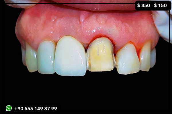 prix des services dentaires en Espagne, prix des soins dentaires en Turquie, implants dentaires Espagne vs Turquie, coût des facettes dentaires Espagne vs Turquie, meilleures cliniques dentaires en Turquie, relooking des dents en Turquie, sourire hollywoodien Turquie, tourisme dentaire Espagne vs Turquie, blanchiment des dents Turquie, restauration complète de la bouche Turquie, traitement dentaire abordable Turquie, implants dentaires bon marché Turquie, couronnes en zircone Turquie, facettes en porcelaine Turquie, forfaits dentaires Turquie, implants all-on-4 Turquie, implants all-on-6 Turquie, meilleures cliniques dentaires Istanbul, vacances dentaires Turquie, agences de voyages dentaires en Turquie, cliniques dentaires sûres en Turquie