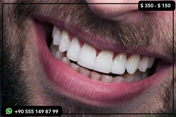 precios de servicios dentales en el Reino Unido, precios dentales en Turquía, tratamiento dental en Turquía, implantes dentales en Turquía, carillas en Turquía, dientes en Turquía, turismo dental en Turquía, mejores clínicas dentales en Turquía, atención dental asequible, sonrisa de Hollywood en Turquía, blanqueamiento dental en Turquía, cambio de imagen dental en Turquía, atención dental en el extranjero, costos dentales en el Reino Unido frente a Turquía, restauración de boca completa en Turquía, clínica dental en Turquía, implantes dentales baratos en Turquía, carillas en Turquía, viajes dentales en Turquía, odontología cosmética en Turquía